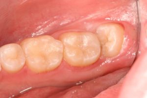 wisdom tooth extraction